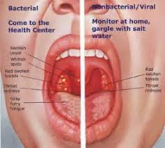 پاورپوینت آشنایی با بیماری های فارنژیت و برونشیت